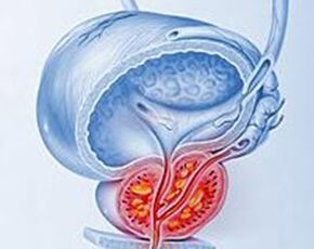 простатитпен простатаның қабынуы